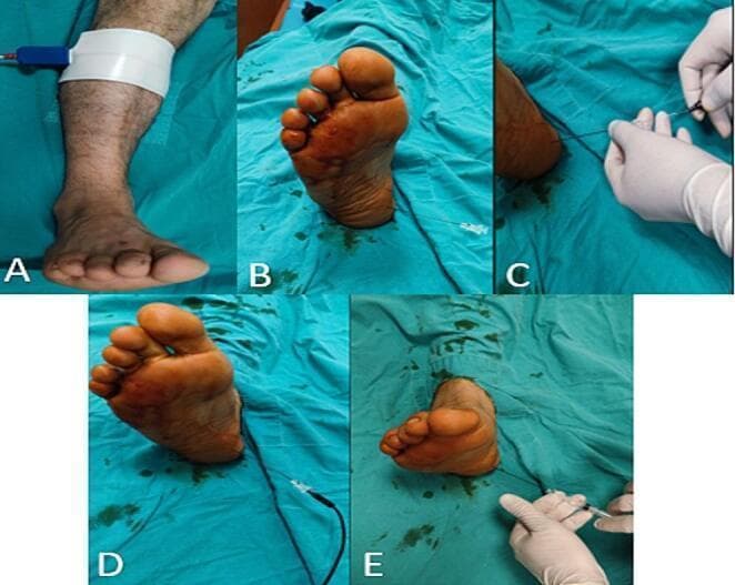 A multi-panel clinical photograph series depicting the sequential stages of pulsed radiofrequency ablation (PRFA) for the treatment of plantar fasciitis or heel pain. Panel A illustrates the preparatory phase with a return electrode (grounding pad) secured to the patient's posterior calf using white adhesive tape. Panels B through E demonstrate the procedural intervention at the anteromedial calcaneus of the foot, which is positioned on a sterile blue surgical drape. The sequence shows the initial application of a hypodermic cannula with a stylet (B), the removal of the stylet and subsequent insertion of the radiofrequency electrode by a gloved clinician (C), the delivery of radiofrequency energy with the electrode connected to a black cable (D), and the post-procedure administration of a local anesthetic substance (e.g., bupivacaine) via syringe (E). This educational visual demonstrates the precise anatomical targeting, instrument handling, and sterile technique required for minimally invasive nerve ablation in podiatry and pain management.