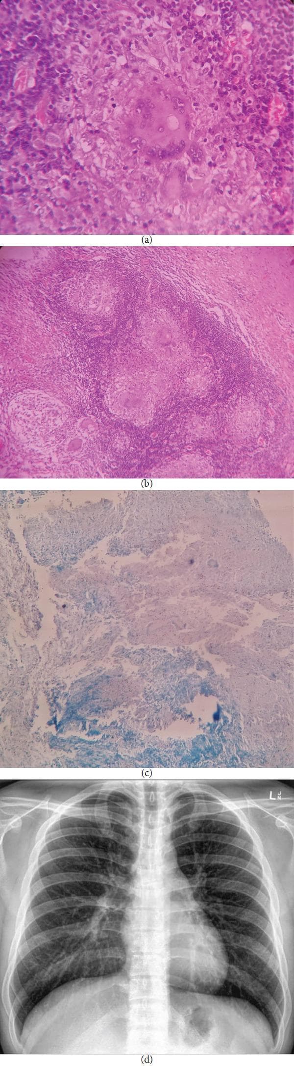 A multi-panel medical image illustrating diagnostic findings for tuberculosis. (a) High-magnification (40x) H&E stained photomicrograph showing a well-formed granuloma with central caseous necrosis, surrounded by epithelioid cells, Langhans-type multinucleated giant cells, and a peripheral rim of chronic inflammatory cells. (b) Lower-magnification (10x) H&E stained photomicrograph displaying multiple coalescing granulomatous lesions within the connective tissue. (c) Photomicrograph using Ziehl-Neelsen (ZN) stain highlighting acid-fast bacilli, visible as small pink/red rod-shaped structures against a methylene blue background, confirmatory for Mycobacterium species. (d) Posteroanterior (PA) view chest X-ray demonstrating clear lung fields with normal bronchovascular markings and no evidence of active pulmonary infiltrates, consolidation, or hilar lymphadenopathy. This visual set educates on the histopathological diagnosis of extrapulmonary tuberculosis (such as primary oral TB) where localized granulomatous inflammation is present despite a normal systemic radiological presentation.