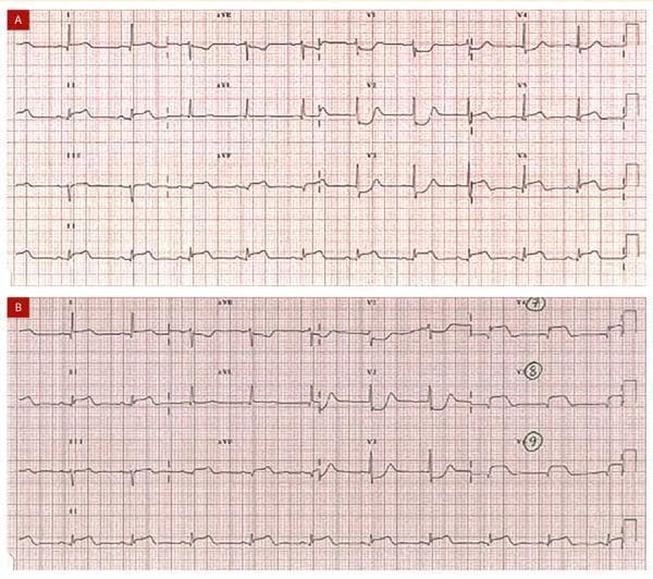 This diagnostic image consists of two electrocardiograms (ECGs) labeled A and B, demonstrating findings indicative of an inferobasal (posterior) myocardial infarction. Image A is a standard 12-lead ECG showing significant ST-segment elevation in the inferior leads (DII, DIII, and aVF). Simultaneously, mirror-image (reciprocal) changes are visible in the precordial leads V1-V3, characterized by horizontal ST-segment depression, prominent R waves with an R/S ratio > 1 in V2, and upright T waves. Image B displays a modified lead placement including posterior leads V7, V8, and V9. In this tracing, the posterior leads (specifically V8 and V9) reveal direct ST-segment elevation, confirming the posterior wall involvement that was suggested by the reciprocal changes in the standard precordial leads of Image A. The comparison illustrates the clinical importance of utilizing posterior leads when anterior ST depression is present to identify a 'hidden' posterior STEMI. This content is relevant for cardiology training and emergency medicine, focusing on acute coronary syndrome diagnostics.