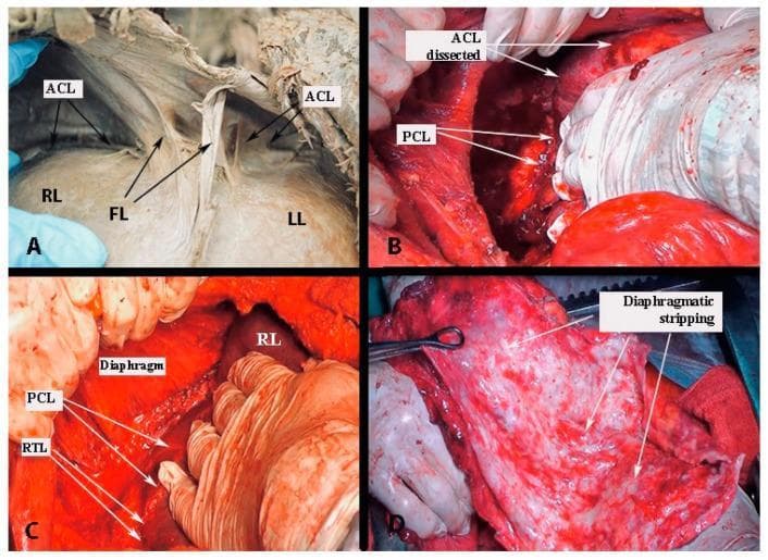 This composite of clinical and cadaveric photographs illustrates the surgical anatomy and mobilization of the liver. Panel A is a cadaveric dissection showing the right lobe (RL) and left lobe (LL) of the liver, with the falciform ligament (FL) and the anterior layer of the coronary ligament (ACL) highlighted. Panels B, C, and D demonstrate steps of liver mobilization and diaphragmatic stripping during open surgery, likely for oncological cytoreduction. Panel B shows the dissection of the ACL and the posterior layer of the coronary ligament (PCL). Panel C visualizes the relationship between the diaphragm, the right lobe (RL), PCL, and the right triangular ligament (RTL) during mobilization. Panel D displays the final appearance of diaphragmatic stripping, characterized by a raw, roughened, and hyperemic surface following the removal of the diaphragmatic peritoneum, often performed in cases of massive metastatic disease. The collection serves as an educational guide for surgeons to identify hepatic ligaments and safely mobilize the liver to access the retroperitoneal space and diaphragm.