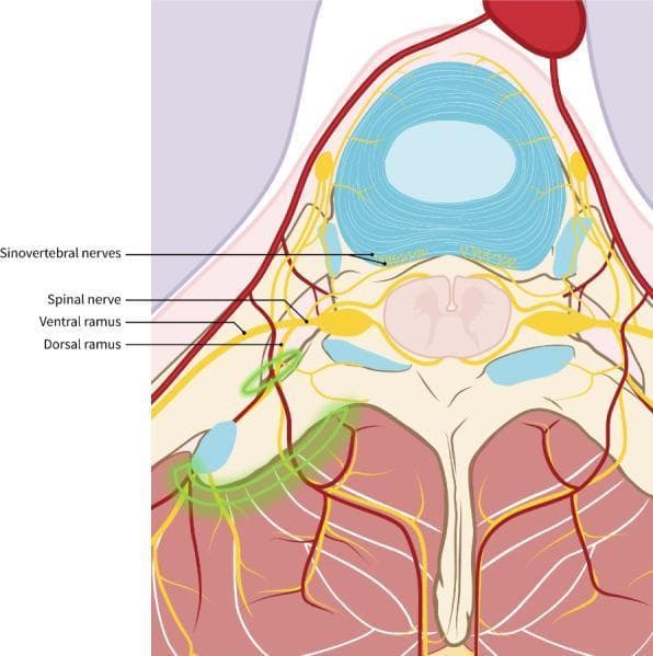 This medical anatomical diagram illustrates the sensory innervation of the vertebral column and surrounding musculature in an axial cross-section. Key anatomical structures labeled include the spinal nerve, which bifurcates into the ventral ramus and dorsal ramus. The diagram highlights the sinuvertebral nerves (recurrent meningeal nerves) arising from the ventral ramus and gray ramus communicans to provide innervation to the intervertebral disc and posterior longitudinal ligament. A distinctive green highlighted area overlays the dorsal ramus and the paraspinal muscles, specifically the erector spinae group. This green zone represents the targeted spread of local anesthetic during an Erector Spinae Plane (ESP) block. The illustration demonstrates the clinical relevance of regional anesthesia, showing how the block consistently covers the dorsal ramus responsible for posterior trunk sensation and back muscle innervation, while contrasting this with the more anteriorly located ventral ramus and sinuvertebral nerves that supply the vertebral bodies and discs. This content is suitable for medical education focusing on regional anesthesia, pain management, and spinal anatomy.