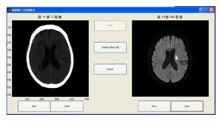 This Comparison Chart illustrates the side-by-side diagnostic evaluation of an ischemic stroke using a customized computer-aided assessment interface. The left panel shows an axial Non-Contrast Computed Tomography (NCCT) scan of the brain, demonstrating the characteristic hyperdense skull and low-contrast parenchyma where early subtle hypodensity might represent an acute infarct. The right panel displays a corresponding Magnetic Resonance Image (MRI), likely a Diffusion-Weighted Imaging (DWI) sequence, of the same patient. This MRI shows a distinct, localized hyperintense (bright) lesion in the left hemisphere adjacent to the lateral ventricle, which clearly delineates the area of acute cerebral infarction. The comparison highlights the higher sensitivity of MRI over CT in the hyperacute and acute phases of stroke. The interface includes navigational controls and analysis buttons ('RUN', 'Select Other DIR', 'SAVE'), indicating its use as a clinical decision support tool designed to assist radiologists in identifying and localizing stroke-affected regions.