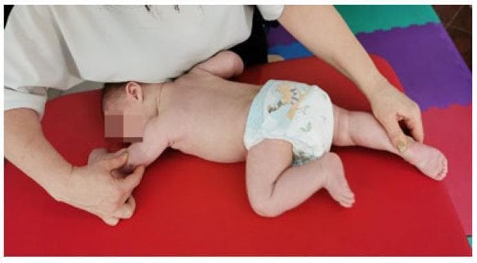 A clinical photograph illustrating a pediatric physical therapy session, specifically demonstrating Vojta therapy and the reflex crawling (Reflexkriechen) technique. The infant is positioned in a prone posture on a stable red treatment surface within a clinical or educational setting. A therapist's hands are visible, applying specific tactile stimuli and directional pressure to trigger global motor patterns. The infant's posture shows asymmetrical limb positioning characteristic of the crawling reflex: one arm is extended while the ipsilateral leg is flexed toward the torso, and the opposite limbs are in a complementary state of extension and flexion. This technique is often used in the rehabilitation of motor development delays and conditions such as muscular torticollis to improve neurological maturation and postural control. The image serves as an educational example of neuro-developmental treatment (NDT) and the assessment of primitive reflexes in infants.