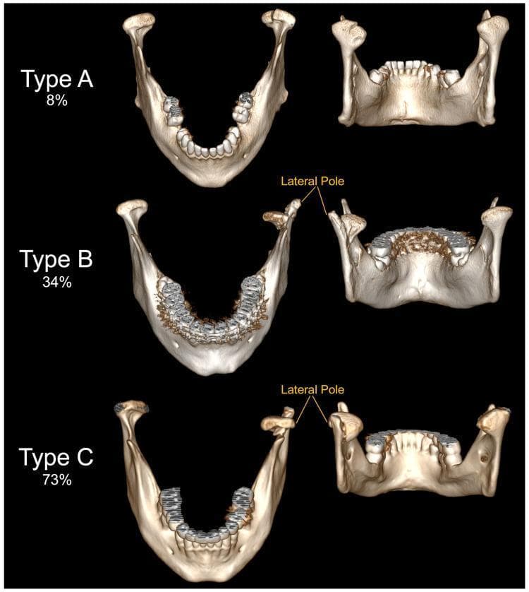This diagnostic comparison chart features 3D reconstructions of the human mandible, demonstrating the Neff classification of mandibular head fractures. The content is organized into three rows, labeled Type A, Type B, and Type C, with percentages indicating clinical incidence. Each row provides a superior view and a posterior-oblique view of the mandible. Type A (8%): The fracture line involves the articular surface near the medial pole, with minimal structural displacement. Type B (34%): The fracture line is localized at the medial pole of the mandibular head, while the lateral pole remains anatomically intact and connected to the ramus. Type C (73%): The fracture line occurs below the lateral pole. This results in the detachment and anteroinferior displacement of the entire mandibular head (including the lateral pole) from the distal mandibular fragment. Labels highlight the 'Lateral Pole' to emphasize its varying integrity across the three types. This educational material is designed for maxillofacial surgery and radiology indexing, illustrating biomechanical outcomes of condylar process trauma.