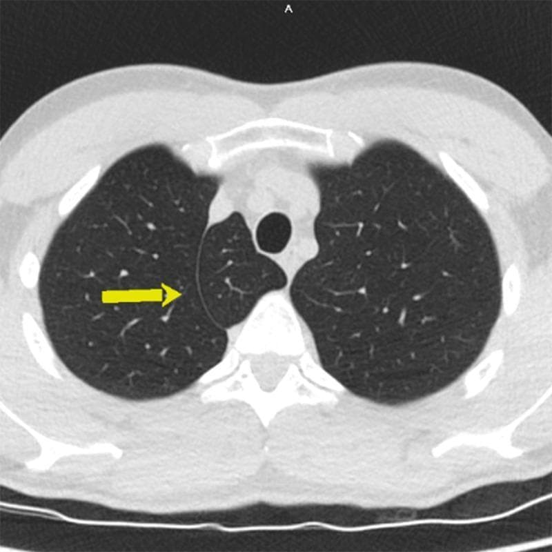 An axial CT scan of the chest at the level of the upper lobes, displaying a common anatomical variant known as an azygos lobe in the right lung. The image shows a characteristic azygos fissure (indicated by a yellow arrow) coursing through the right apical lung parenchyma. This fissure is formed by the anomalous lateral course of the azygos vein, which creates a 'mesoazygos' consisting of four layers of pleura. The resulting azygos lobe is a small, well-defined medial segment of the right upper lobe. The surrounding lung parenchyma appears normally aerated with standard bronchovascular markings. The central airway (trachea) and mediastinal structures are visible and midline. This diagnostic image serves as a classic educational example of a non-pathological thoracic variation that should be distinguished from pulmonary masses or apical scarring during radiological interpretation.