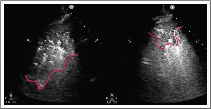 This dual-panel diagnostic lung ultrasound illustrates the effect of Positive End-Expiratory Pressure (PEEP) on pulmonary recruitment and reaeration. Both images demonstrate localized lung consolidation, indicated by red outline markers. In the left panel (PEEP 5), a larger area of tissue-like echogenicity is visible, characterized by a heterogeneous, 'hepatized' appearance with dynamic air bronchograms, signifying significant loss of aeration. Outside the consolidated boundary, horizontal hyperechoic A-lines suggest aerated lung. The right panel (PEEP 15) shows a marked reduction in the size of the consolidated region following the increase in PEEP. This visual change represents recruitment of previously collapsed alveoli and an improved fluid-to-gas ratio within the lung parenchyma. The decrease in the C-pattern (consolidation) and the prevalence of A-lines in the surrounding tissue correlate with improved clinical aeration scores. This comparison is a key educational tool for critical care medicine, demonstrating the utility of point-of-care ultrasound (POCUS) in monitoring ventilator adjustments and managing conditions like ARDS or pneumonia.