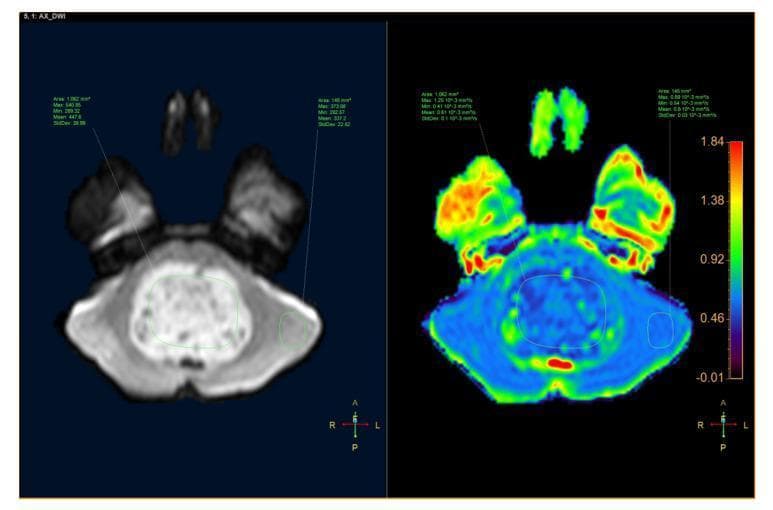 This diagnostic image pair displays an axial brain MRI of an 8-year-old male with a confirmed medulloblastoma in the fourth ventricle. The left panel shows a Diffusion-Weighted Image (DWI) where the tumor exhibits high signal intensity (hyperintensity), indicating restricted diffusion. The right panel shows the corresponding Apparent Diffusion Coefficient (ADC) map, where the tumor appears with low signal intensity (blue/green hues), confirming true diffusion restriction rather than a T2 shine-through effect. Green Regions of Interest (ROI) are demarcated on both images for quantitative analysis. Annotations provide statistical data for the tumor ROI and a control parenchyma ROI, including Area, Max, Min, Mean, and Standard Deviation. On the ADC map, the tumor mean ADC is 0.81 x 10^-3 mm^2/s, while the reference parenchyma mean is 337.2. A color scale on the right correlates signal intensity with quantitative ADC values. This comparison is clinically significant for the differential diagnosis of posterior fossa tumors in pediatric patients, specifically distinguishing highly cellular tumors like medulloblastoma from other entities such as brainstem gliomas.