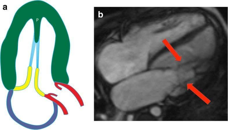 This composite image illustrates the anatomy of a parachute mitral valve (PMV) through a schematic diagram and a diagnostic cardiac MRI. Panel A is an anatomical diagram showing the characteristic single papillary muscle (labeled 'P') within the left ventricle, from which all chordae tendineae (blue) originate. This configuration forces the mitral valve leaflets (yellow) into a restricted, funnel-like shape resembling a parachute. Panel B shows a four-chamber steady-state free precession (SSFP) cardiac MRI sequence. Red arrows indicate the convergent attachment of multiple chordae tendineae to a solitary, centrally located papillary muscle, rather than the typical distribution between anterolateral and posteromedial muscles. This rare congenital anomaly is a significant finding in pediatric and adult cardiology, often associated with mitral stenosis due to reduced leaflet mobility and restricted valve orifice area. It may also present as part of the Shone complex. The image serves as an educational tool for identifying atypical subvalvular apparatus morphology in congenital heart disease.