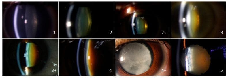 This set of eight slit-lamp clinical photographs demonstrates the Standard Pre-Operative Nuclear Classification System (SPONCS) for grading nuclear cataracts. The images, taken at a 45-degree angle, show the progression of lens opacification and nuclear color changes. Grade 1 shows a relatively clear lens with a faint bluish-white tint and visible cortical layers. As the severity progresses through grades 2, 2+, 3, and 3+, the lens nucleus undergoes a chromatic transition from mild yellowing to deep amber and orange. By grades 4 and 4+, the nucleus exhibits pronounced yellow-brown discoloration with significant cloudiness. Grade 5 represents an advanced brunescent cataract with a dark brown, opaque nucleus. The slit-lamp beam reflection simultaneously evolves from a sharp, well-defined section in lower grades to a highly scattered, diffuse reflection in higher grades, reflecting increased lens density and light scattering. This visual scale serves as a standardized tool for ophthalmologists to assess cataract maturity and plan surgical intervention, specifically correlating with cumulative dissipated energy (CDE) during phacoemulsification.