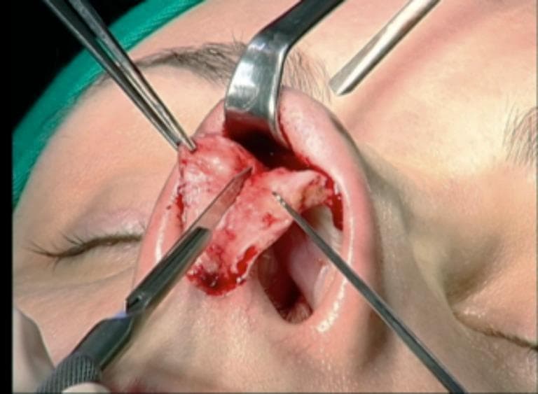 This clinical photograph captures a close-up of an open rhinoplasty procedure focusing on the exposure of the nasal septum. The surgical field demonstrates the elevation of the mucoperichondrial flap from the underlying septal cartilage, creating a sub-mucoperichondrial plane. The septum appears as a central, whitish-pink structure composed of smooth cartilage and more rigid posterior bone. Several surgical instruments are in use: a retractor is positioned superiorly to provide exposure of the osteocartilaginous dorsum, forceps are holding soft tissue edges, and a scalpel is performing a precise incision or dissection along the septal cartilage. A sharp elevator or probe is also visible, assisting in tissue manipulation. Hemorrhagic spots are present throughout the field, typical of active dissection. This image illustrates a critical stage in septal surgery, necessary for correcting deviations or harvesting graft material, such as spreader grafts, to improve the internal nasal valve and airway patency.