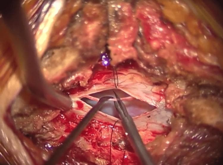 This intraoperative clinical photograph captures a microsurgical procedure for tethered cord syndrome, specifically the untethering of the filum terminale at the L5/S1 vertebral level. The surgical field demonstrates a longitudinal durotomy, with the edges of the incision retracted by stay sutures to expose the underlying neural elements. The filum terminale, appearing as a thin, whitish-grey fibrous band, is being meticulously isolated and manipulated using specialized microsurgical instruments, including a nerve hook and microscissors. The surrounding dura mater is visible as a translucent white membrane with fine vasculature, while the deeper surgical bed shows the dark void of the spinal canal. Hemorrhagic staining and soft tissue dissection planes are evident at the margins of the incision. This image illustrates the critical step of identifying and sectioning the filum terminale to relieve tension on the spinal cord, a key procedure in neurosurgery and orthopedic spine surgery.