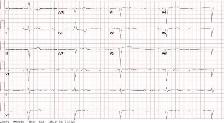 A 12-lead electrocardiogram (ECG) demonstrating a complete atrioventricular (AV) block, also known as third-degree heart block. The diagnostic image shows total AV dissociation characterized by a lack of relationship between P waves and QRS complexes. The atrial rate is significantly faster and independent of the ventricular rate. The ventricular escape rhythm is slow (bradycardic) with wide QRS complexes (duration >120 ms), indicating the escape rhythm originates from a ventricular or infra-Hisian site. Prominent features include deep S waves in the precordial leads (V1-V3) and T-wave inversions in several leads, including I, II, aVL, and V4-V6. This tracing represents a postoperative clinical scenario following tricuspid valve replacement, illustrating a known complication of congenital heart surgery. The ECG is recorded at standard settings of 25 mm/s and 10 mm/mV, serving as a critical educational tool for identifying life-threatening conduction system failures and the necessity for pacing interventions.