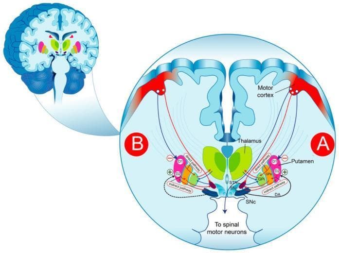 This medical illustration presents a comparative pathophysiology diagram of the basal ganglia circuitry in a physiological state (A) and Parkinson’s Disease (B). The diagram utilizes a coronal brain section view to detail the dopaminergic (DA) regulation of movement. Key anatomical structures labeled include the Motor Cortex, Thalamus, Putamen (striatum), Substantia Nigra pars compacta (SNc), Substantia Nigra reticulata (SNr), Subthalamic Nucleus (STN), Globus Pallidus externa (GPe), and Globus Pallidus interna (GPi). The 'direct pathway' is depicted via D1-receptor-mediated inhibitory projections from the putamen directly to the GPi/SNr, facilitating movement. The 'indirect pathway' is shown via D2-receptor-mediated projections through the GPe and STN, ultimately inhibiting movement. Comparison A highlights healthy dopamine release from the SNc, while Comparison B illustrates the neurodegenerative depletion of dopamine (indicated by dashed lines), resulting in overactivity of the indirect pathway and increased inhibition of the thalamocortical loop. This educational visual explains the mechanistic basis for bradykinesia and motor symptoms in Parkinson’s Disease.
