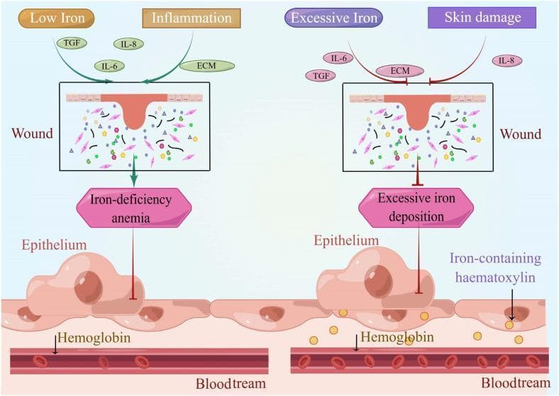 A comparative medical illustration detailing the effects of iron dysregulation on wound healing and systemic states. The left panel depicts a 'Low Iron' and 'Inflammation' scenario where a cutaneous wound is associated with 'Iron-deficiency anemia'. Key signaling molecules shown include TGF, IL-6, IL-8, and ECM components within a wound bed containing fibroblasts and matrix elements. An arrow indicates the downstream impact on the underlying epithelium and hemoglobin within the bloodstream. The right panel depicts an 'Excessive Iron' and 'Skin damage' scenario characterized by 'Excessive iron deposition'. This state is visually distinguished by an inhibitory symbol (red T-bar) directed at the epithelium, suggesting impaired regenerative capacity. Notably, the epithelium in the high-iron state contains yellow granules labeled as 'Iron-containing haematoxylin' (hemosiderin), which serve as a histological marker of iron overload. Both panels show the anatomical relationship between the cutaneous wound, underlying epithelial cells, and the intravascular space (bloodstream) containing red blood cells and hemoglobin, illustrating how iron homeostasis is critical for normal dermatological repair and systemic oxygen transport.