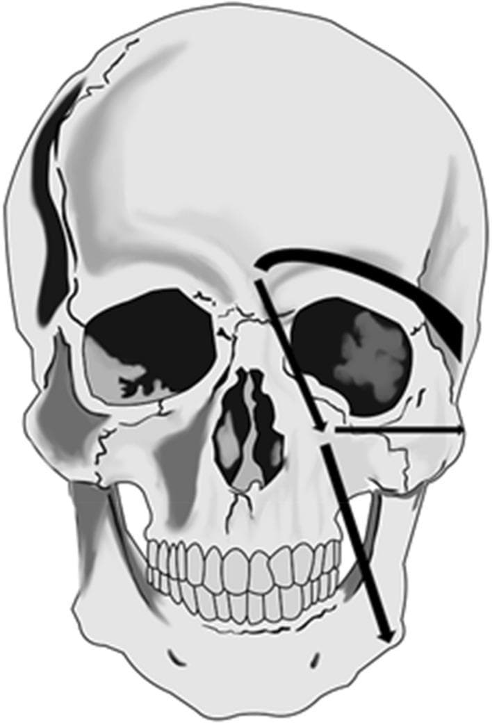 This anatomical diagram presents an anterior view of a human skull overlaid with schematic arrows illustrating facial lymphatic drainage pathways. The illustration focuses on the primary drainage routes from two specific injection sites on the left side of the face (viewer's right). The supra-ocular pathway is shown as a superiorly arching arrow originating above the orbit and directing toward the pre-auricular lymph nodes. The para-nasal pathway originates near the nasal bridge and divides into three distinct directions: inferiorly toward the sub-mandibular lymph nodes, laterally toward the parotid lymph nodes, and superior-laterally toward the pre-auricular lymph nodes. This diagram is utilized in nuclear medicine and clinical anatomy to demonstrate typical patterns of lymphoscintigraphy tracer movement and to highlight the anatomical landmarks (orbit, nasal cavity, mandible) used to map lymphatic flow in patients with facial edema or lymphedema.