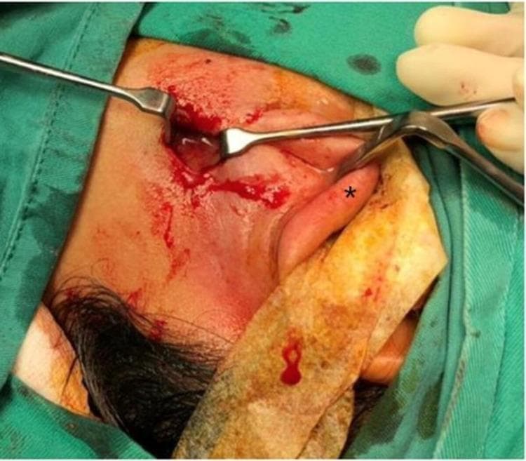 This clinical photograph captures an intraoperative view of a parotid abscess drainage procedure. The surgical field is focused on the preauricular and infraauricular region of the left side of the face. A 'mini' modified Blair skin incision has been performed to access the parotid gland. Key anatomical landmarks include the ear lobule, which is marked with an asterisk (*) and is being retracted superiorly and posteriorly away from the surgical site to provide adequate exposure. Small surgical retractors are being used to hold the incision open, revealing a cavity from which purulent material is being drained. The surrounding skin is prepped with antiseptic and shows mild erythema and surgical blood staining. Sterile green surgical drapes surround the area, and a gloved hand and gauze are visible at the periphery of the field. This image serves as an educational example of the surgical approach and technique for draining deep-seated parotid space infections while minimizing the surgical footprint through a modified incision.