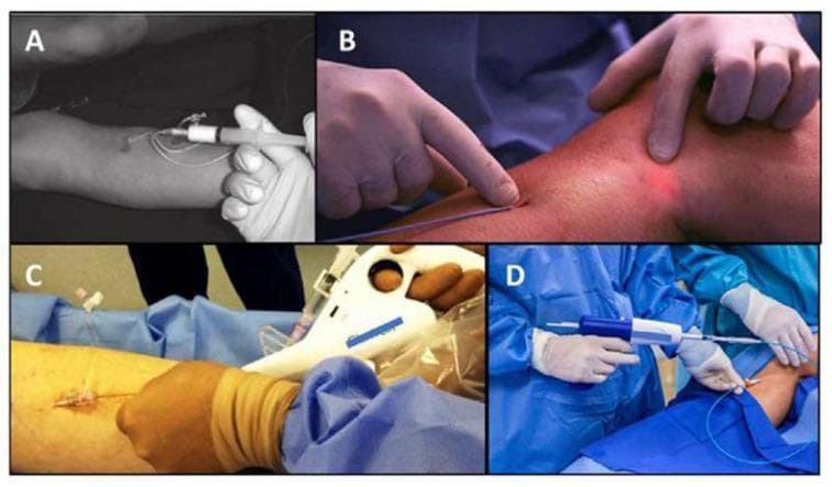 This composite of four clinical photographs illustrates various endovenous treatment modalities for saphenous vein insufficiency and varicose veins. Image A shows ultrasound-guided foam sclerotherapy, featuring a syringe connected to a catheter for injecting chemical sclerosants. Image B demonstrates Endovenous Laser Ablation (EVLA), where a thin laser fiber is inserted into the vein; a red transillumination light on the skin surface indicates the laser tip position. Image C depicts mechanochemical ablation (MOCA), showing a specialized motorized handle device that combines mechanical endothelial damage with simultaneous sclerosant infusion. Image D displays cyanoacrylate embolization (medical glue injection), featuring a gun-like delivery system used to deploy an adhesive agent into the vein lumen via a catheter. All procedures are minimally invasive, performed through small percutaneous access points on the lower extremity. The images serve to compare thermal and non-thermal, non-tumescent (NTNT) techniques in modern phlebology, highlighting the diverse instrumentation used for venous occlusion.