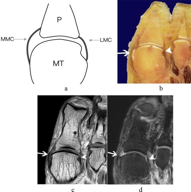 This composite educational resource depicts the anatomy of the medial (MMC) and lateral main collateral ligaments (LMC) of the first metatarsophalangeal joint (MTPJ) using four distinct modalities. (a) A transverse schematic diagram illustrates the origin of the ligaments on the metatarsal head (MT) and their insertion on the proximal phalangeal base (P). (b) A transverse anatomic slice of a cadaveric specimen shows the physical structure of these ligaments as supportive bands flanking the joint. (c) A transverse T1-weighted image (T1WI) and (d) a transverse T2-SPAIR MRI sequence demonstrate the clinical presentation of these structures. In both MRI modalities, the ligaments are visualized as distinct, curved, hypointense (dark) signal bands. White arrows indicate the medial collateral ligament, while white arrowheads point to the lateral collateral ligament. The collection serves to correlate gross anatomy with radiological findings, highlighting the ligaments' role in stabilizing the first MTPJ and their typical low-signal appearance on standard MRI sequences used for musculoskeletal assessment.