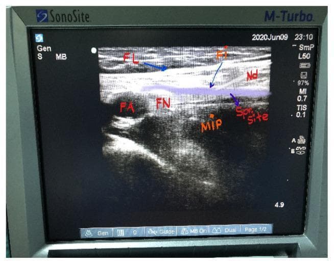 This diagnostic ultrasound image demonstrates a Ultrasound-Guided Fascia Iliaca Compartment Block (FICB) in the inguinal region. The primary anatomical landmarks are labeled: the Fascia Lata (FL) and Fascia Iliaca (FI) appear as distinct, parallel hyperechoic (bright) linear structures. Deep to these layers, the Femoral Artery (FA) and Femoral Nerve (FN) are visible, along with the hypoechoic Musculus Iliopsoas (MIP). A block needle (Nd) is visualized as a hyperechoic linear instrument advancing toward the potential space deep to the fascia iliaca. The 'Sp Site' (spread site) highlights a hypoechoic area representing the deposition and distribution of local anesthetic within the iliacus compartment, confirming successful needle placement. This image serves as an educational reference for regional anesthesia techniques, illustrating the anatomical planes and real-time visualization required for safe needle guidance and adequate anesthetic spread to target the femoral, obturator, and lateral femoral cutaneous nerves.
