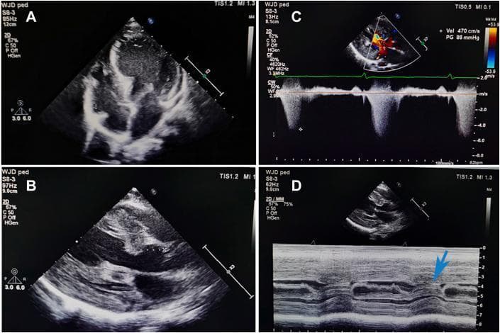 Transthoracic echocardiogram (TTE) panel illustrating hypertrophic cardiomyopathy and left ventricular outflow tract (LVOT) obstruction. Image A shows an apical four-chamber view at end-diastole, highlighting severe asymmetric septal hypertrophy and thickened ventricular walls. Image B displays a parasternal long-axis view at end-systole, further demonstrating the increased myocardial thickness. Image C features a continuous-wave Doppler spectral display through the LVOT; the high-velocity, dagger-shaped waveform indicates a peak velocity of 4.7 m/s and a significant peak pressure gradient of 88 mmHg, consistent with severe obstruction. Image D utilizes M-mode echocardiography to visualize systolic anterior motion (SAM) of the mitral valve (indicated by a blue arrow), where the anterior mitral leaflet makes contact with the interventricular septum during systole. This composite clinical image serves as an educational tool for diagnosing dynamic LVOT obstruction and assessing hemodynamic severity in patients with myocardial hypertrophy.
