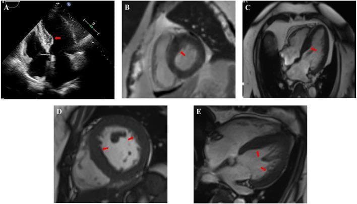 This composite figure presents clinical imaging findings for two cases of Hypertrophic Cardiomyopathy (HCM), utilizing echocardiography and cardiac MRI. Images A-C (Case 2) demonstrate significant asymmetric septal hypertrophy. Panel A (echocardiogram) shows marked thickening at the base of the interventricular septum (IVS). Panels B (short-axis view) and C (four-chamber view) of the cardiac MRI confirm uneven thickening of the basal and intermediate IVS segments, indicated by red arrows, reaching 20-22 mm, while the left ventricular lateral wall remains at a normal thickness of 8-10 mm. Images D-E (Case 3) provide cardiac MRI views showing a less severe but distinct septal thickening of approximately 14-16 mm. Red arrows highlight the non-uniform ventricular wall thickening, contrasting with a lateral wall thickness of 9-11 mm. These imaging modalities illustrate the hallmark features of HCM, including disproportionate septal-to-lateral wall ratios and the heterogeneous distribution of myocardial hypertrophy, essential for distinguishing hereditary cardiomyopathy from secondary causes like hypertensive heart disease.