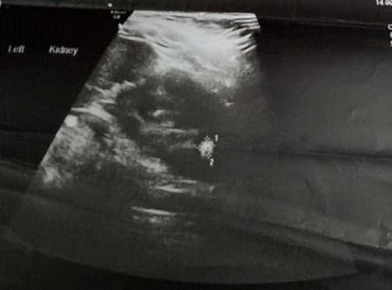 This diagnostic ultrasound image depicts the left kidney in a longitudinal view, labeled 'Left Kidney'. The scan reveals significant hydronephrosis characterized by a dilated renal pelvis measuring 13 mm, appearing as an anechoic (dark) fluid-filled space within the central collecting system. Within the dilated pelvis, there is a large, highly echogenic (bright) focus approximately 2 cm in diameter, labeled with points '1' and '2'. This finding is consistent with a large renal pelvic calculus (urolithiasis). The surrounding renal parenchyma shows a heterogeneous echotexture. This image is clinically significant for demonstrating obstructive uropathy caused by a large stone, leading to pelvic dilatation. It serves as an educational tool for identifying renal stones and secondary signs of obstruction like hydronephrosis in pediatric or adult urology.