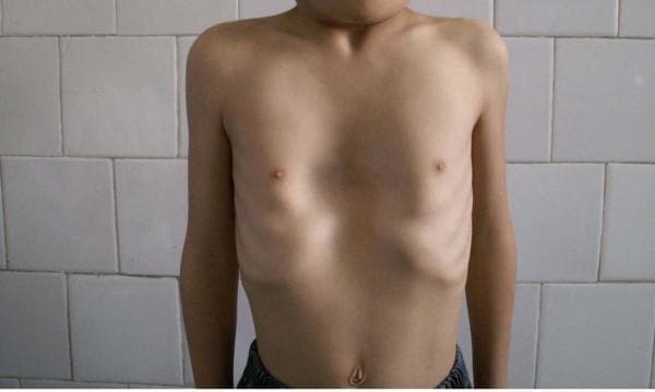 This clinical photograph shows the anterior torso of an 8-year-old male demonstrating a classic presentation of pectus excavatum, a congenital chest wall deformity. The primary feature is a significant posterior depression of the sternum and adjacent costal cartilages, resulting in a sunken or 'funnel chest' appearance. The indentation is most pronounced in the mid-to-lower sternal region, just above the epigastrium. Visually, this creates a hollowed central chest cavity with a compensatory outward appearance of the lateral ribcage and lower costal margins. The patient exhibits slight protraction of the shoulders and a slender habitus, common postural associations with this condition. This image serves as an educational example of musculoskeletal pathology in pediatric thoracic surgery and orthopedics, illustrating the visual manifestations used to assess the severity of chest wall malformations.