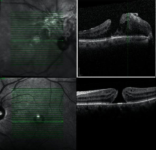 This composite diagnostic image displays macular Optical Coherence Tomography (OCT) scans and corresponding fundus images for both eyes, illustrating advanced vitreoretinal pathology. The top panels show the right eye (OD) exhibiting a lamellar macular hole. A prominent, hyperreflective epiretinal membrane (ERM) is visible, extending from the optic nerve head to the fovea, exerting tangential traction that has resulted in intra-retinal edema and structural disruption. The bottom panels show the left eye (OS) demonstrating a full-thickness macular hole (FTMH), characterized by a complete absence of neurosensory retinal tissue at the fovea, creating a distinct vertical void through all retinal layers. Fundus images on the left utilize green raster scan indicators to map the cross-sectional OCT segments. This clinical visualization is essential for differentiating partial versus full-thickness macular defects and assessing the impact of epiretinal traction on retinal architecture in ophthalmology.