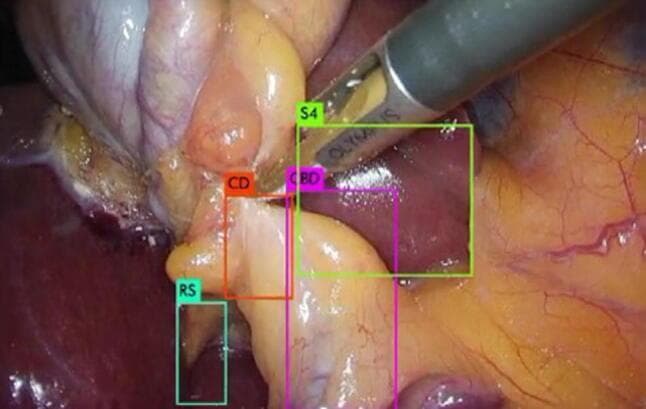 This endoscopic clinical photograph depicts a laparoscopic cholecystectomy, focusing on the hepatocystic triangle (Calot's triangle). The image features four key anatomical landmarks identified by artificial intelligence bounding boxes for surgical navigation: the cystic duct (CD), common bile duct (CBD), the lower edge of the left medial liver segment (S4), and Rouviere’s sulcus (RS). The cystic duct is shown as a pale, tubular structure centrally located, while the common bile duct lies adjacent to it. Rouviere’s sulcus is visible as a distinct fissure in the liver parenchyma, serving as an important extrabiliary landmark to identify the plane of the common bile duct. The image demonstrates the 'Critical View of Safety' technique, aimed at preventing bile duct injuries by clearly identifying these structures before clipping or cutting. A laparoscopic instrument is positioned superiorly near segment 4 of the liver. This visual is designed for surgical training in hepatobiliary surgery and the application of deep learning algorithms in computer-assisted surgery.