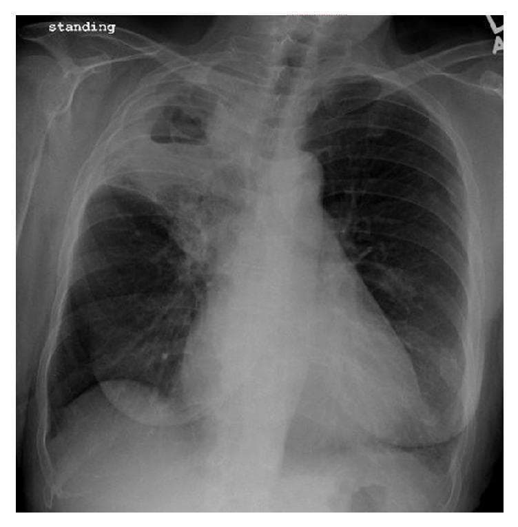 A posterior-anterior (PA) chest X-ray in a standing position demonstrating a significant pathological process localized to the right upper lobe. The primary finding is a dense, consolidated opacity involving the right upper lobe, clearly demarcated by the minor fissure. Within this consolidated region, there is a large, well-defined cavitary lesion containing a distinct horizontal air-fluid level, characteristic of necrotizing pneumonia or a lung abscess. The surrounding lung parenchyma in the right middle and lower lobes appears relatively aerated, though there is a subtle increase in interstitial markings. The left lung field remains clear with normal vascularity and no evidence of consolidation, effusion, or cavitation. The cardiac silhouette, mediastinal contours, and costophrenic angles appear within normal limits. This radiographic presentation is highly suggestive of cavitating pneumonia, potentially caused by virulent pathogens such as Pseudomonas aeruginosa, Klebsiella pneumoniae, or Staphylococcus aureus. The image serves as a clinical example of lung parenchyma destruction and abscess formation in the context of severe pulmonary infection.