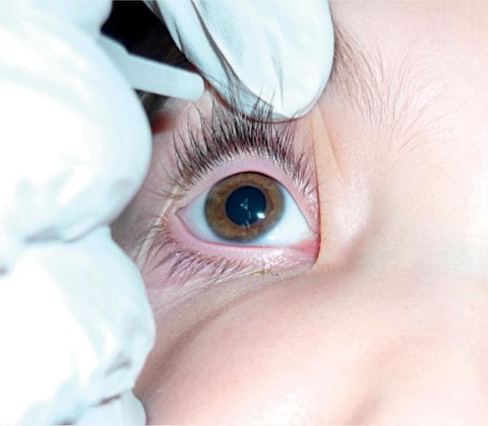 This clinical photograph demonstrates a medical procedural technique for ophthalmic drug administration. The image shows the eye of a patient with a brown iris and clear sclera. A healthcare provider wearing white examination gloves is seen gently retracting both the upper and lower eyelids. The lower eyelid is pulled downward (eversion) to expose the inferior conjunctival sac (fornix), creating a pocket for the instillation of eye drops or ointment. This specific technique is utilized in pediatric or non-cooperative patients to ensure ocular access without applying direct pressure to the globe. Key anatomical structures visible include the palpebral conjunctiva, eyelid margins with eyelashes, and the corneal surface. The image serves as an educational guide for nursing and clinical skills, focusing on proper patient handling and infection control through the use of gloves during topical ocular therapy.