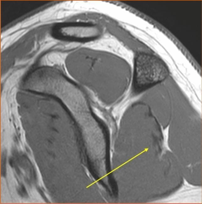 This T1-weighted sagittal MRI image displays a cross-section of the human shoulder, specifically focusing on the anatomical orientation of the rotator cuff muscles. The infraspinatus muscle is prominently featured, containing several low-signal (dark) bands representing intramuscular tendons. A yellow arrow points to a specific anatomical variant where these intramuscular tendons are judged as 'partly superficial.' Unlike tendons that remain entirely encased within the muscle belly, these structures extend toward and course along the posterior surface of the muscle. The high-contrast T1-weighted sequence allows for clear differentiation between the lower-signal dense fibrous connective tissue of the tendons and the relatively higher-signal intensity of the surrounding muscle fibers. This image serves as a clinical reference for identifying anatomical variations in the internal architecture of the infraspinatus, which is critical for understanding musculoskeletal biomechanics and potential sites for tendinopathy or tear propagation.