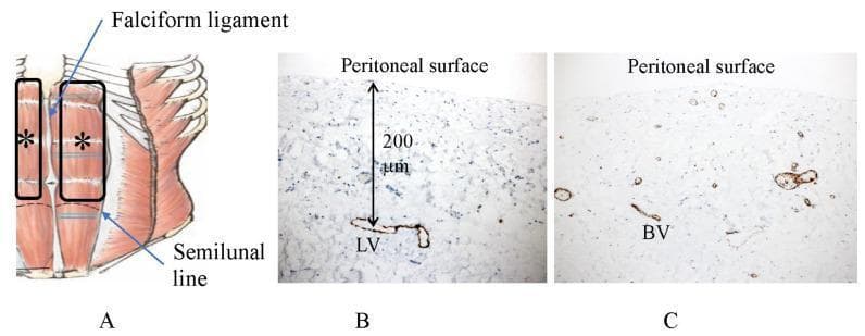 This composite educational image illustrates the vascular anatomy of the human anterior abdominal wall and peritoneum through a combination of an anatomical diagram and immunohistochemical staining. Image A is an anatomical diagram showing the distribution of subperitoneal blood vessels extending from the hypochondrium to the semilunal line, excluding the area of the falciform ligament (marked with an asterisk). Image B is a photomicrograph of D2-40 immunostaining demonstrating a subperitoneal lymphatic vessel (LV) situated approximately 200 μm beneath the peritoneal surface. Image C shows CD31 immunostaining of submesothelial blood vessels (BV) in the same region, highlighting a relatively scarce vascular density and different morphology compared to the lymphatic network. This image serves to educate on the spatial organization of the blood-peritoneal barrier (BPB) and the specific depth and distribution of initial lymphatic vessels, which are critical for understanding peritoneal fluid absorption and the pathways of trans-lymphatic cancer metastasis.
