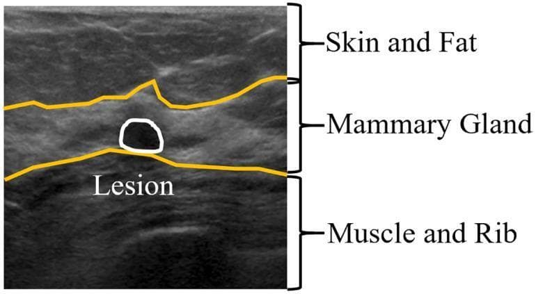 This diagnostic anatomical diagram features a breast ultrasound (BUS) image annotated to illustrate the typical layered structure of breast tissue. From superficial to deep, the three primary layers are identified: 1) the Skin and Fat layer, which presents as a relatively hyperechoic (brighter) and heterogeneous area; 2) the Mammary Gland layer, which is delineated by yellow boundary lines and serves as the primary functional tissue; and 3) the Muscle and Rib layer, characterized by lower echogenicity and deeper anatomical positioning. Within the mammary gland layer, a specific focal finding is highlighted: a rounded, hypoechoic (darker) lesion enclosed by a white circular outline. The diagram demonstrates the importance of anatomical localization for lesion detection in clinical sonography, specifically highlighting that breast pathology typically originates within the mammary gland zone. This educational material is designed for radiology students or medical professionals to improve pattern recognition in B-mode breast ultrasonography.