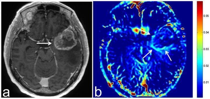 This diagnostic image pair features magnetic resonance imaging (MRI) of a brain metastasis from esophageal cancer in a 70-year-old male. Image (a) is an axial, three-dimensional, contrast-enhanced T1-weighted sequence showing a large, peripherally enhancing (ring-enhancing) lesion in the left temporal lobe. The metastasis exhibits an irregular border and a hypointense central area, suggesting central necrosis or cystic change. Image (b) shows the corresponding axial Amide Proton Transfer-weighted Chemical Exchange Saturation Transfer (APT-CEST) sequence. This molecular imaging modality displays a relatively high signal intensity (SI) at the tumor margin (highlighted by white arrows), represented by yellow-red hues on the accompanying color bar (approx. 0.03 to 0.05). The high APT signal at the periphery correlates with increased concentrations of endogenous mobile proteins and peptides, often associated with high cellular proliferation in malignant tumor margins. In contrast, the internal regions and surrounding healthy brain tissue show lower signal intensities (blue-green hues), providing metabolic differentiation of the lesion.