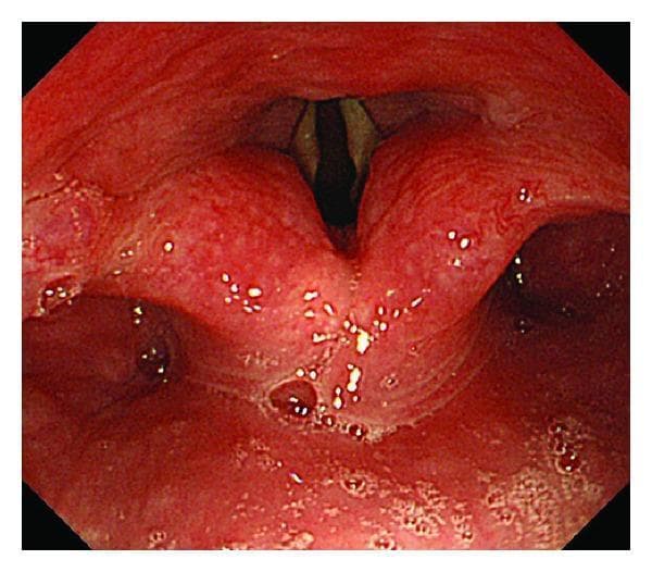 This clinical photograph shows a laryngoscopic view of the human hypopharynx and larynx during propofol induction. The primary focus is the glottic opening, where the true vocal cords (vocal folds) are visible as elongated, pale structures positioned centrally. The vocal cords are partially abducted, revealing a dark, narrow glottic space; however, the tracheal cartilage is not visualized due to the degree of glottic closure. The surrounding supraglottic structures, including the arytenoids and aryepiglottic folds, exhibit a pinkish-red hue with areas of surface cobblestoning and minor secretions (visible as bright white specks), which may indicate mild irritation or chronic inflammation. The piriform recesses are visible on either side. This diagnostic image serves as an educational tool for evaluating laryngeal anatomy, vocal cord patency, and airway assessment during pharmacological sedation. Key educational concepts include glottic visualization, mucosal assessment, and pharyngeal function during anesthesia.
