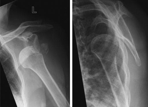 This diagnostic image consists of two radiographic views of the left shoulder (anteroposterior and Y-view) demonstrating a traumatic anterior glenohumeral dislocation. The humeral head is significantly displaced anteriorly and inferiorly relative to the glenoid fossa. Associated with the dislocation is a comminuted avulsion fracture of the greater tuberosity. A distinct, irregular bony fragment is visible, having been pulled from its anatomical position on the proximal humerus and displaced superiorly and laterally. The scapula, including the glenoid rim and acromion, appears otherwise intact, though normal joint alignment is lost. This clinical image is characteristic of acute shoulder trauma and is used to illustrate the typical presentation of a combined glenohumeral dislocation and rotator cuff-related bony avulsion, common in adult patients.
