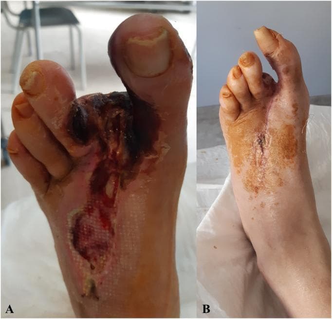 This clinical photograph set provides a side-by-side comparison of a patient's left foot before (A) and three weeks after (B) vascular intervention for peripheral artery disease. Panel A illustrates a severe, longitudinally-oriented ischemic ulcer on the dorsal aspect of the foot, extending into the first interdigital space. The wound displays dark necrotic tissue (eschar), exposed subcutaneous layers, and signs of secondary infection with surrounding erythema and inflammatory changes. A mesh-patterned wound dressing is visible within the proximal ulcer bed. Panel B shows the same foot following successful revascularization and wound management. The primary ulcer has been surgically closed, evidenced by a midline incision secured with sutures or staples. The necrotic tissue is resolved, and there is a significant reduction in peripheral edema and inflammation. Residual hyperpigmentation and staining from topical antiseptic use are visible on the distal skin. This comparison highlights the clinical progression from critical limb-threatening ischemia (CLTI) to successful wound healing and limb salvage.