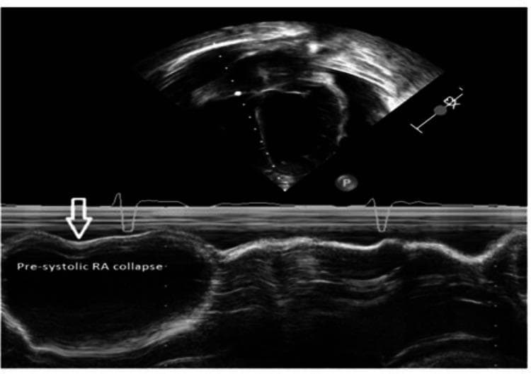 This diagnostic image is a transthoracic echocardiogram combining a B-mode sector view (top) and an M-mode tracing (bottom) to demonstrate findings consistent with cardiac tamponade. The top sector view shows a cross-section of the cardiac chambers surrounded by a large anechoic space, representing a massive pericardial effusion. The bottom M-mode tracing focuses on the right atrial (RA) wall dynamics. A white arrow and text annotation highlight a pre-systolic RA collapse, characterized by an inward invagination or concavity of the RA free wall during late diastole. This finding occurs when intrapericardial pressure exceeds intracavitary right atrial pressure, serving as a highly sensitive sign for impending hemodynamic compromise in the setting of pericardial effusion. An overlaid electrocardiogram (ECG) tracing allows for temporal correlation of wall motion with the cardiac cycle, confirming the timing of the collapse. This educational visual is critical for training in cardiology and emergency medicine to recognize early sonographic markers of cardiac tamponade.