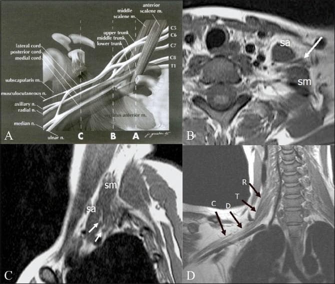 This composite educational graphic illustrates the normal anatomy of the brachial plexus through anatomical diagrams and Magnetic Resonance Imaging (MRI). Panel A is an anatomical diagram depicting the plexus architecture from roots (C5-T1) to terminal branches, labeled with musculoskeletal landmarks like the scalene muscles and coracoid process. Panel B (axial) and Panel C (sagittal) are T1-weighted MRI scans demonstrating the interscalene triangle, defined by the anterior scalene (sa) and middle scalene (sm) muscles. These muscles serve as primary radiological landmarks for identifying the neural roots and trunks (indicated by arrows). Panel D provides an oblique coronal T1-weighted MRI view, tracing the sequential segments of the right brachial plexus: roots (R), trunks (T), divisions (D), and cords (C). This resource is designed for medical education in radiology and neurology to assist in the localization of neural structures and the diagnostic evaluation of conditions like brachial plexopathy, neurogenic tumors, or Pancoast tumors.