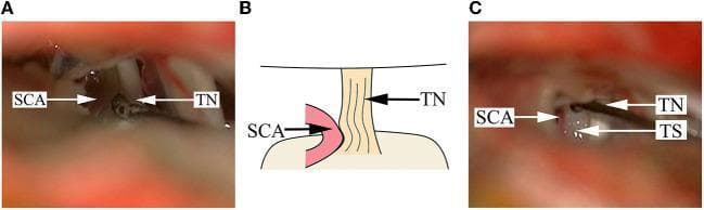 This composite educational image illustrates a microvascular decompression (MVD) procedure for trigeminal neuralgia caused by neurovascular conflict. Panel A is an intraoperative clinical photograph showing the superior cerebellar artery (SCA) severely impacting the cisternal segment of the trigeminal nerve (TN). The nerve root appears visibly dark, deformed, and depressed due to chronic arterial compression. Panel B provides a simplified anatomical diagram of the neurovascular conflict, highlighting the point of contact where the arterial loop displaces the nerve fiber bundle. Panel C is a postoperative intraoperative photograph demonstrating the surgical resolution: the SCA has been mobilized away from the TN, and a white, fibrous Teflon sponge (TS) has been interposed as a permanent cushion between the vessel and the nerve root. This content demonstrates key surgical landmarks in the cerebellopontine angle and the mechanical basis of trigeminal decompression.