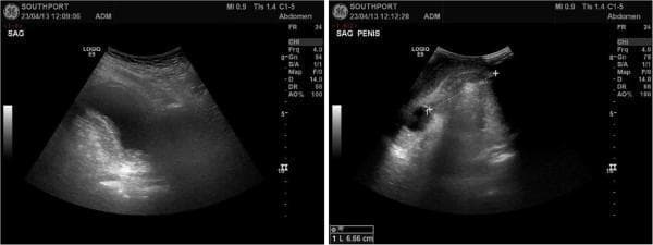 This diagnostic ultrasound image consists of two panels illustrating the clinical complication of an incorrectly positioned Foley catheter. The left panel, a sagittal abdominal scan (labeled 'SAG'), displays a view of the urinary bladder which is notably empty, with no Foley catheter balloon visualized within the lumen. The right panel, labeled 'SAG PENIS', shows a sagittal ultrasound view of the penile anatomy. In this image, a rounded, anechoic (dark) structure representing the inflated balloon of a Foley catheter is clearly visible, malpositioned within the membranous urethra rather than the bladder. Electronic calipers on the right panel measure the distance from the tip of the penis to the center of the balloon, recorded at 6.66 cm. This comparison demonstrates 'non-drainage' of urine caused by urethral catheterization failure, where the balloon is inflated prematurely in the urethra instead of the bladder lumen. The clinical significance involves the risk of urethral trauma and secondary hematuria.