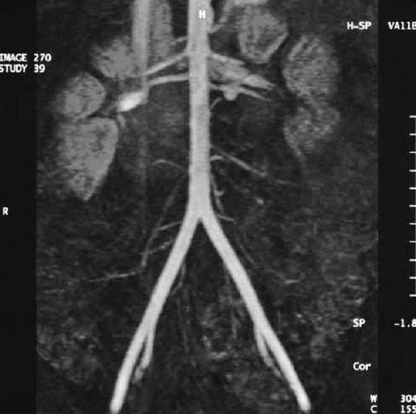 This diagnostic image is a Magnetic Resonance Angiography (MRA) or Angio-MRI of the abdominal aorta and its major branches, presented in a coronal Maximum Intensity Projection (MIP). The central vascular structure is the abdominal aorta, which descends vertically with a straight course. It shows bilateral branching into the renal arteries, which supply the kidneys visualized as paired, mottled, bean-shaped lateral masses. Inferiorly, the aorta exhibits a clear bifurcation at the level of the aortic bifurcation into the left and right common iliac arteries. Smaller mesenteric and lumbar arterial branches are visible along the aortic trunk. The image serves as an educational tool for studying abdominal vascular anatomy, the renal blood supply, and the primary arterial distribution in the retroperitoneum. Clinical relevance includes the assessment of vascular patency, stenosis, or aneurysmal changes in the aorta and iliac system.