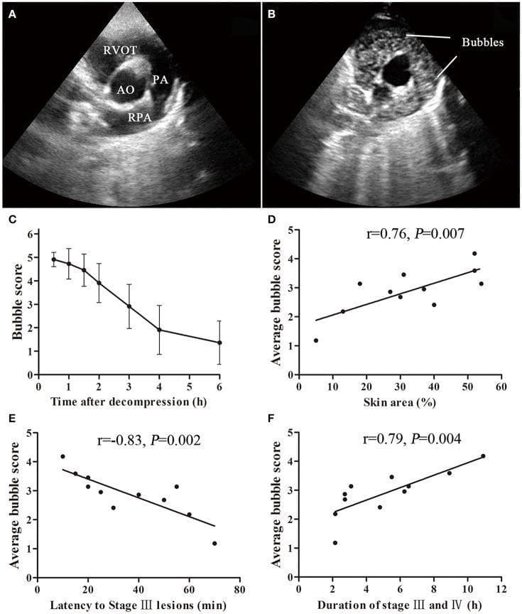 This composite educational image illustrates the pathophysiology of decompression sickness (DCS). Panels A and B present echocardiographic images (parasternal short-axis view at the aortic root level). Panel A shows normal anatomy including the Aorta (AO), Right Ventricular Outflow Tract (RVOT), Pulmonary Artery (PA), and Right Pulmonary Artery (RPA). Panel B demonstrates the presence of circulating venous gas emboli, visible as hyperechoic, bright punctate 'bubbles' within the RVOT and PA. Panel C is a line graph showing the temporal decline of bubble scores over a 6-hour post-decompression period. Panels D, E, and F are scatter plots with linear regression analysis demonstrating the clinical correlation between bubble load and cutaneous manifestations of DCS. These charts show that higher bubble scores correlate with larger skin lesion areas (r=0.76), shorter latency to the onset of Stage III lesions (r=-0.83), and longer duration of severe skin symptoms (r=0.79). The material serves to teach the relationship between intravascular gas formation and the severity of systemic DCS symptoms.