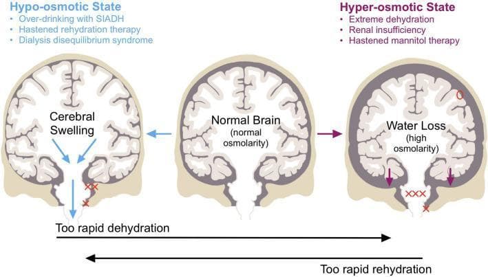This medical illustration depicts the effects of acute plasma osmolality shifts on the brain in a coronal cross-section. The diagram is divided into three panels: a central 'Normal Brain' (normal osmolarity), a 'Hypo-osmotic State' (left), and a 'Hyper-osmotic State' (right). The hypo-osmotic panel illustrates cerebral swelling typically caused by SIADH, rapid rehydration, or dialysis disequilibrium. Key findings include brainstem downward displacement (indicated by blue arrows) and contusions (red X/XX) from contact with the meninges and foramen magnum. The hyper-osmotic panel illustrates water loss and brain shrinkage due to dehydration, renal insufficiency, or rapid mannitol therapy. Significant markers include the brain 'sinking' (magenta arrows), stretching of cortical vessels (indicated by 'O'), and pontine white matter demyelination ('XXX'). A horizontal axis at the bottom highlights the risks of 'Too rapid dehydration' and 'Too rapid rehydration' as iatrogenic drivers of these transitions. The illustration serves as a clinical guide for understanding the Monro-Kellie doctrine and the mechanical consequences of osmotic brain injury, specifically focusing on herniation and vascular damage.