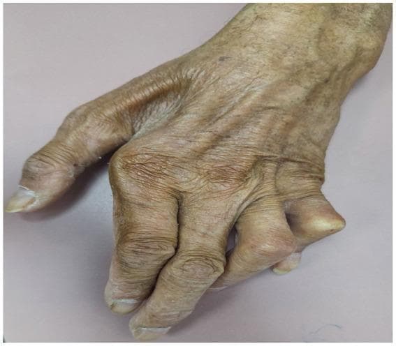 This clinical photograph displays a dorsal view of a human hand exhibiting advanced chronic polyarthritis and joint deformities associated with leprosy. Key visual features include significant ulnar deviation of the digits at the metacarpophalangeal joints and a prominent Boutonniere deformity of the fourth digit, characterized by flexion at the proximal interphalangeal (PIP) joint. The joints appear swollen and misaligned, suggesting a presentation that mimics rheumatoid arthritis. The skin is notably thin, wrinkled, and atrophic with visible underlying vasculature and patchy hyperpigmentation, consistent with age-related changes or long-term chronic disease. The nails show mild scaling and thickening. This image serves as an educational example of how late-stage leprosy can present with severe musculoskeletal manifestations and joint destruction, requiring differentiation from primary rheumatologic conditions.