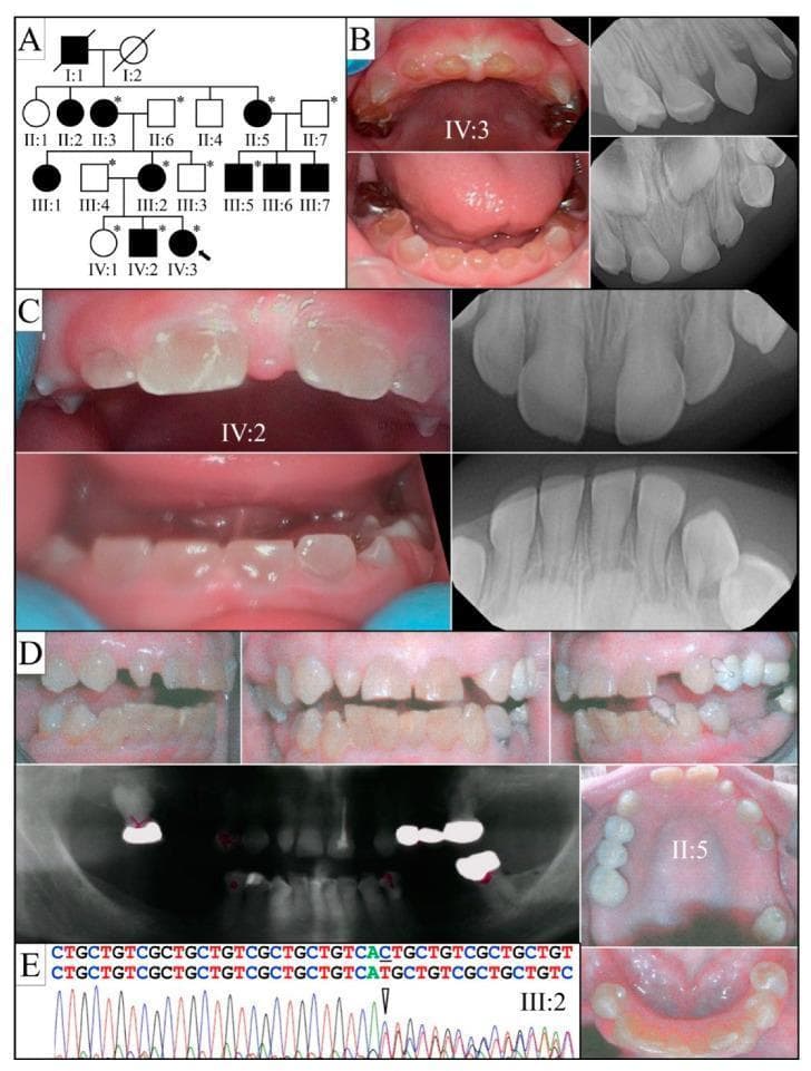 This composite educational graphic details the clinical and genetic presentation of Dentinogenesis Imperfecta Type II (DGI-II) within a single family. Panel A shows a four-generation pedigree indicating an autosomal dominant inheritance pattern. Panels B, C, and D provide clinical photographs and corresponding diagnostic radiographs (panorex and periapical views) of different family members. Clinical photographs demonstrate hallmark features including characteristic amber-brown or opalescent discoloration, significant enamel fracturing (shedding), and extensive occlusal attrition resulting in exposed dentin. Radiographic findings show bulbous crowns, cervical constriction, and the progressive obliteration of pulp chambers and root canals, which are diagnostic indicators of the condition. Panel E displays a sequencing chromatogram identifying a heterozygous frameshift mutation in the DSPP gene (c.3461delG), providing a molecular basis for the observed phenotype. This material illustrates the correlation between genetic mutations, radiographic markers of dentin dysplasia, and the resulting clinical dental pathology.