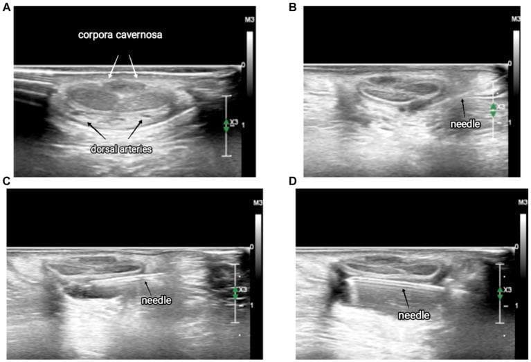 This set of four transverse-view ultrasound images (labeled A-D) illustrates the anatomy and procedural technique for an ultrasound-guided dorsal penile nerve block. Panel A displays the baseline sonoanatomy, identifying the paired corpora cavernosa as central, oval-shaped structures with a medium-gray echotexture, and the smaller, hypoechoic dorsal arteries located inferiorly. Panels B, C, and D demonstrate the dynamic advancement of a hyperechoic (bright) echoic needle using an in-plane approach. The sequence shows the needle entering from the lateral aspect (B), advancing through the fascia to the midline (C), and finally extending beneath the corpora cavernosa toward the contralateral nerve (D). The clinical focus is on visualizing the fascia and vascular structures to ensure precise anesthetic deposition and avoid intravascular injection. This clinical imaging is essential for pediatric anesthesia education regarding safe, regional block techniques for penile procedures.