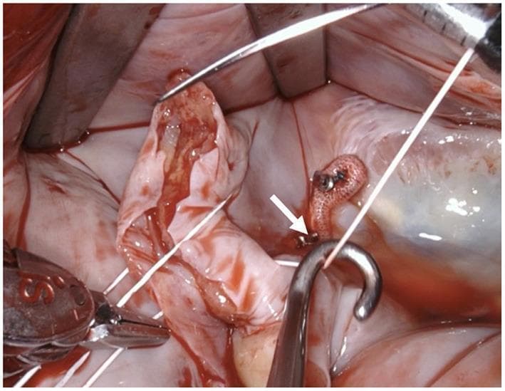 Intraoperative clinical photograph showing a close-up view of a cardiac surgical field, likely during a valve repair or replacement procedure. The image depicts reddish-pink cardiac tissue, possibly a valve leaflet, being manipulated. Key surgical instruments include a stainless steel suture hook in the foreground, applying light traction to a white, braided suture thread to maintain tension. In the lower-left corner, a surgical needle holder or clamp is visible, grasping the other end of the suture. In the center-right background, a small, textured, pinkish-orange prosthetic or pledget-like material is anchored to the tissue with a metallic fastener (indicated by a white arrow). Retractors are positioned at the top of the frame to maintain surgical exposure. The image demonstrates precise tissue handling and suture management techniques essential in cardiovascular surgery.