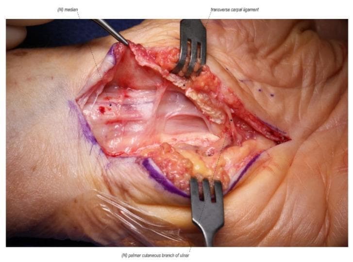 This clinical photograph captures a revision open carpal tunnel release surgical procedure on a left hand. The intraoperative field shows the median nerve, labeled as '(N) median', which exhibits signs of chronic compression, including proximal bruising, edema, and a scarred, thickened texture. The nerve is visibly adherent to the undersurface of the radial leaf of the transverse carpal ligament. The transverse carpal ligament itself is shown partially divided, with its radial and ulnar leaves retracted. Surrounding the surgical site, there is evidence of extensive postoperative fibrosis and scarring from the prior intervention, as well as localized tissue inflammation and disrupted anatomical planes. A surgical probe is used to identify the pathological tethering between the median nerve and the ligamentous tissue. The palmar cutaneous branch is also annotated in the distal surgical field. This image serves as a clinical example of recurrent or persistent carpal tunnel syndrome caused by incomplete primary release and subsequent perineural scar formation.